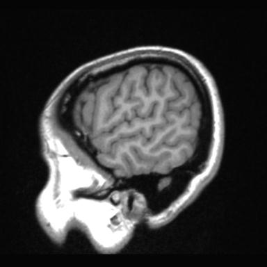 Atretic encephalocoele with inferior vermis hypoplasia (Radiopaedia 30443-31108 Sagittal T1 13).jpg