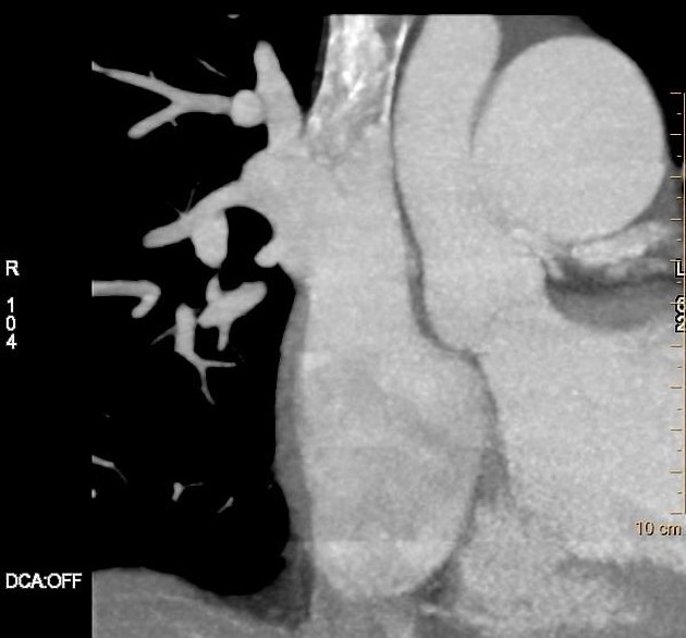 File:Atrial septal defect (upper sinus venosus type) with partial anomalous pulmonary venous return into superior vena cava (Radiopaedia 73228-84051 C+ arterial phase 3).jpeg