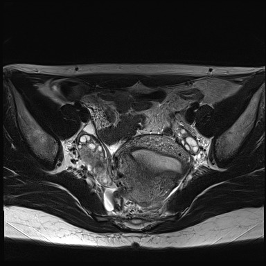 File:Atypical deep infiltrating endometriosis (Radiopaedia 44470-48125 Axial T2 13).jpg
