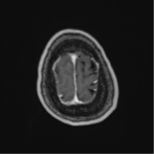 Atypical meningioma (WHO Grade II) (Radiopaedia 54742-60981 Axial T1 C+ 64).png
