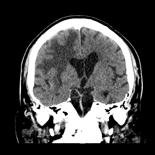Atypical meningioma (WHO grade II) with brain invasion (Radiopaedia 57767-64728 Coronal C+ 31).png