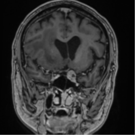 Atypical meningioma (WHO grade II) with brain invasion (Radiopaedia 57767-64729 Coronal T1 C+ 32).png