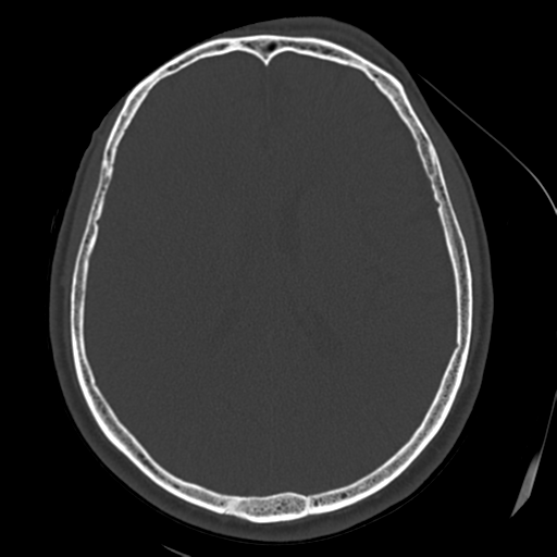 File:Atypical meningioma (WHO grade II) with osseous invasion (Radiopaedia 53654-59715 Axial bone window 48).png