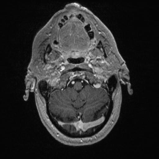 Atypical meningioma (grade II) - en plaque (Radiopaedia 29633-30147 Axial T1 C+ 30).jpg