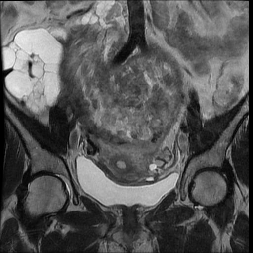 File:Atypical retroperitoneal lymphocoeles with large leiomyoma of uterus (Radiopaedia 32084-33027 Coronal T2 18).jpg