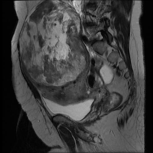 File:Atypical retroperitoneal lymphocoeles with large leiomyoma of uterus (Radiopaedia 32084-33027 Sagittal T2 13).jpg