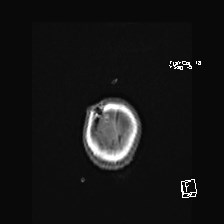 Atypical teratoid rhabdoid tumor (prenatal US and neonatal MRI) (Radiopaedia 59091-66388 Axial T1 53).jpg