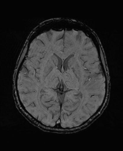 Autoimmune limbic encephalitis (Radiopaedia 30363-31005 SWI 41).jpg
