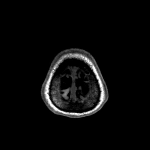 Autoimmune limbic encephalitis (Radiopaedia 30363-31005 T1 Axial 1mm 143).jpg