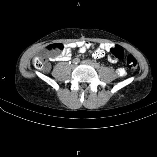 Autoimmune pancreatitis (Radiopaedia 84925-100431 Axial C+ delayed 56).jpg