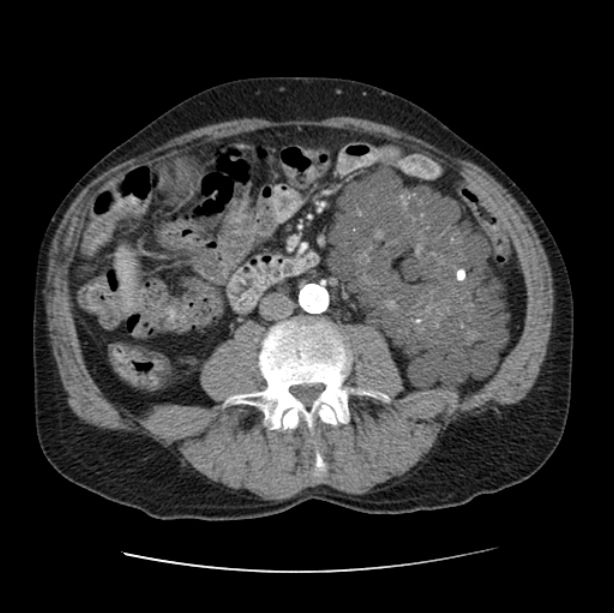 Autosomal dominant polycystic kidney disease (Radiopaedia 27851-28094 B 80).jpg