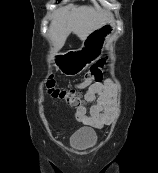 Autosomal dominant polycystic kidney disease (Radiopaedia 38189-40194 Coronal C+ delayed 4).jpg
