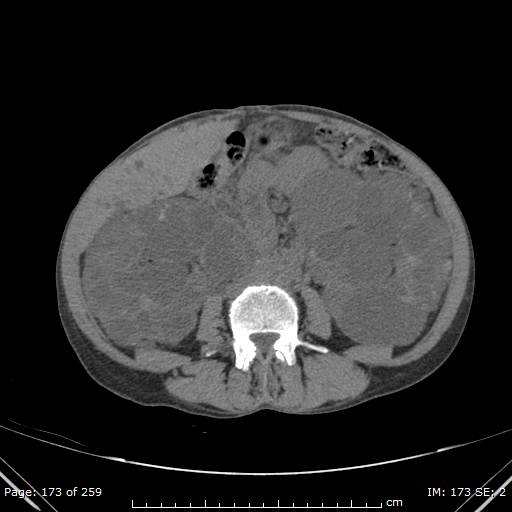 Autosomal dominant polycystic kidney disease (Radiopaedia 44122-47684 Axial non-contrast 62).jpg