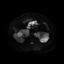 Autosomal dominant polycystic kidney disease (Radiopaedia 50259-55611 Axial DWI 26).jpg