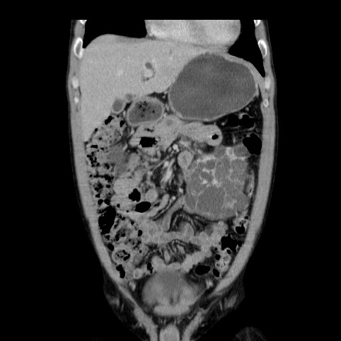 File:Autosomal dominant polycystic kidney disease (Radiopaedia 66349-75582 A 15).jpg