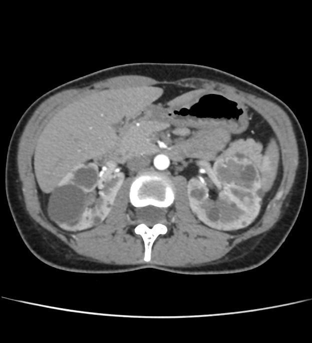 Autosomal dominant polycystic kidney disease - early onset (Radiopaedia 40734-43387 B 20).jpg