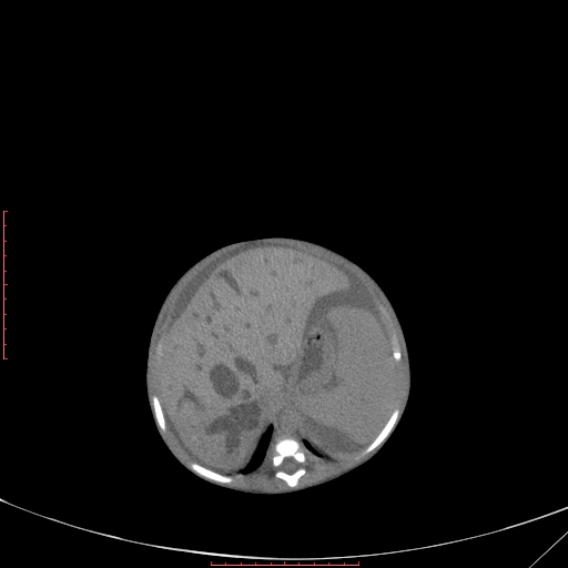 Autosomal recessive polycystic kidney disease associated with Caroli disease (Radiopaedia 61932-69984 B 127).jpg