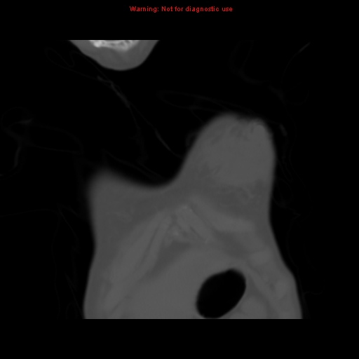 File:Avascular necrosis in sickle cell disease (Radiopaedia 17448-17152 Coronal bone window 5).jpg