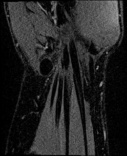 Avascular necrosis of the capitate (Radiopaedia 88317-104948 Coronal T1 vibe 73).jpg