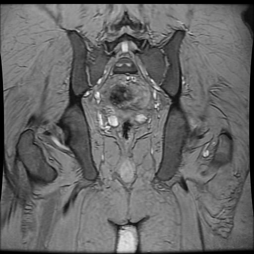 Avascular necrosis of the hip (Radiopaedia 61503-69465 F 74).jpg