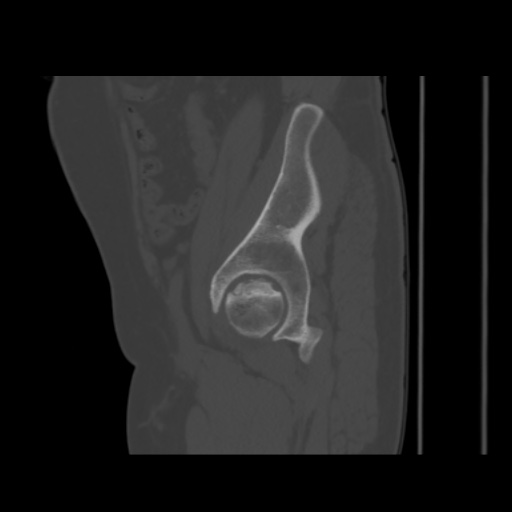 File:Avascular necrosis of the hip (Radiopaedia 61503-69467 B 17).jpg