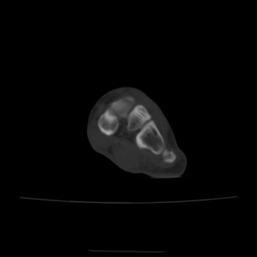 Avulsion fracture of the dorsal cuboid bone (Radiopaedia 51586-57377 Axial bone window 96).jpg