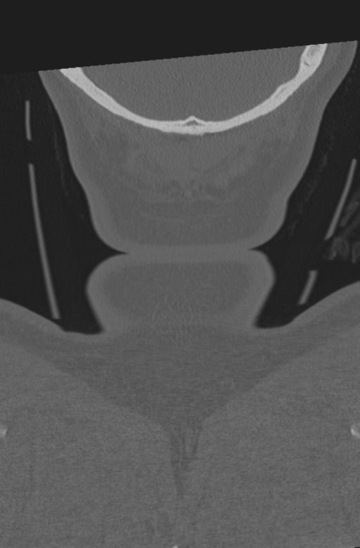 Axis peg fracture (type 3) and atlas lateral mass (type 4) fracture (Radiopaedia 37474-39324 Coronal bone window 72).png