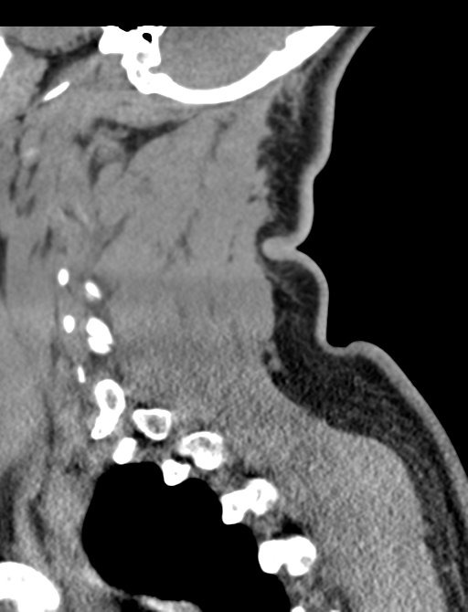 Axis peg fracture (type 3) and atlas lateral mass (type 4) fracture (Radiopaedia 37474-39324 D 59).png
