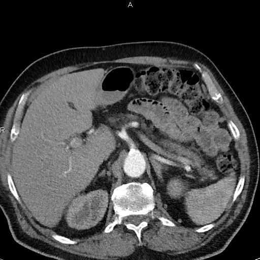 File:Azygos continuation of the inferior vena cava (Radiopaedia 18537-18404 C+ arterial phase 58).jpg
