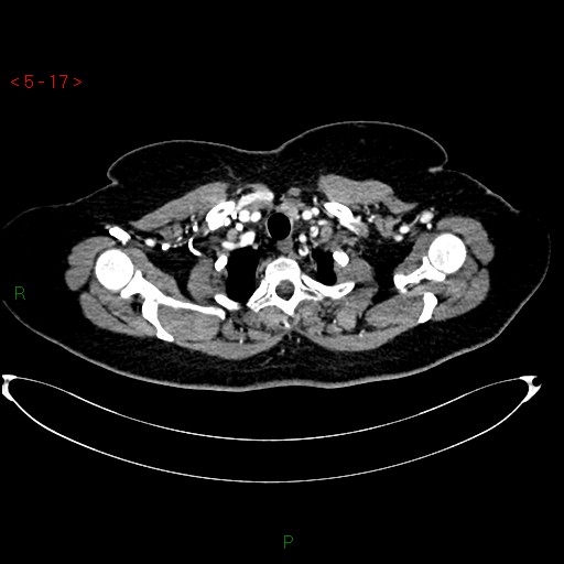 File:Azygos fissure and lobe (Radiopaedia 47620-52278 A 3).jpg