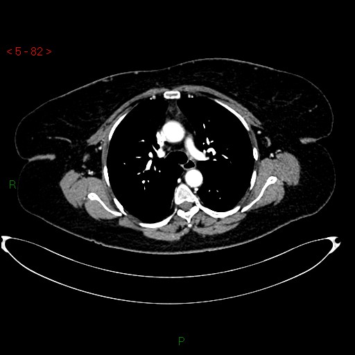 Azygos fissure and lobe (Radiopaedia 47620-52278 A 68).jpg