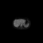 B-cell lymphoma of the mesentery (Radiopaedia 65743-74868 18F-FDG PET-CT 172).jpg