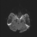 Balo concentric sclerosis (Radiopaedia 50458-55940 Axial DWI 38).jpg