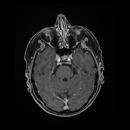 Balo concentric sclerosis (Radiopaedia 53875-59982 Axial LAVA C+ 86).jpg