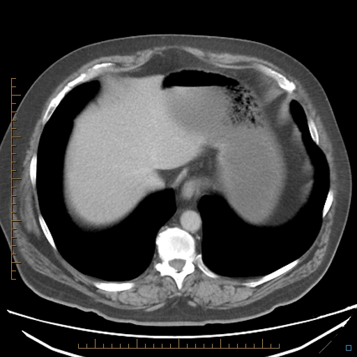 File:Bariatric balloon causing gastric outlet obstruction (Radiopaedia 54449-60672 A 7).jpg