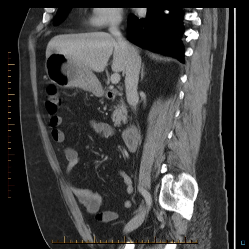 File:Bariatric balloon causing gastric outlet obstruction (Radiopaedia 54449-60672 C 49).jpg