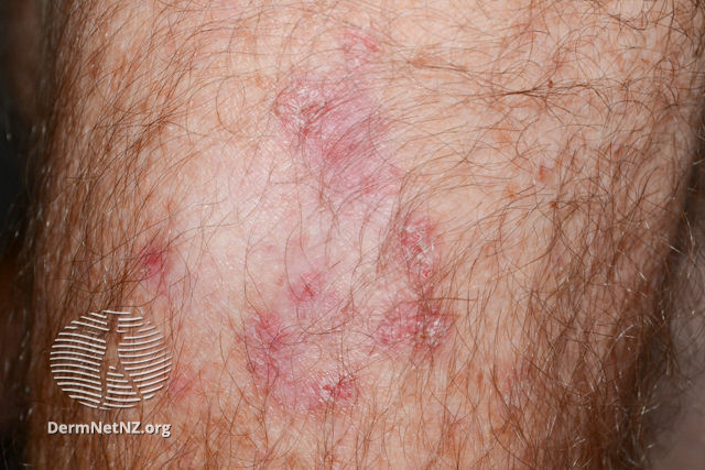 File:Basal cell carcinoma, arm (DermNet NZ bcc-arm-17-dn).jpg
