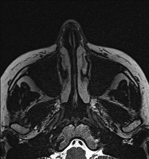 Basal cell carcinoma - nasal region (Radiopaedia 70292-80365 Axial Gradient Echo 9).jpg
