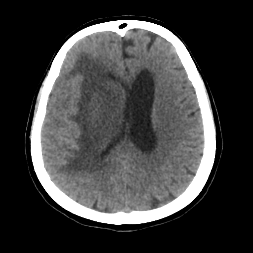 Basal ganglia metastasis (Radiopaedia 78928-91830 Axial non-contrast 40).png