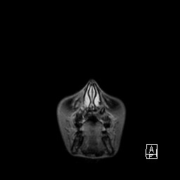Base of skull rhabdomyosarcoma (Radiopaedia 32196-33142 I 9).jpg