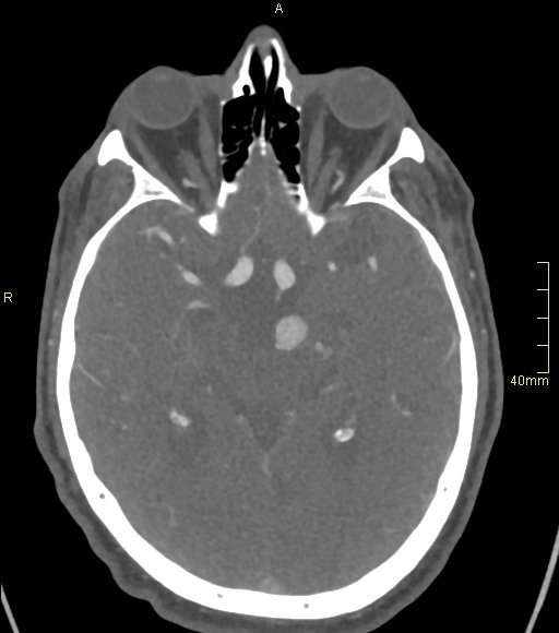 Basilar artery aneurysm (Radiopaedia 56261-62932 A 74).jpg