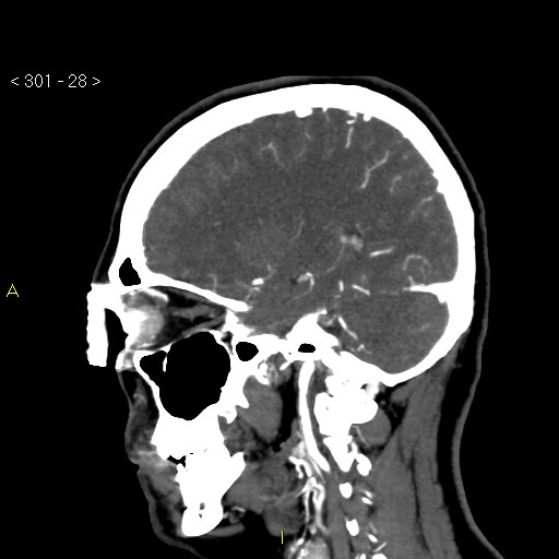 File:Basilar artery thrombosis (Radiopaedia 16260-15944 C 22).jpg