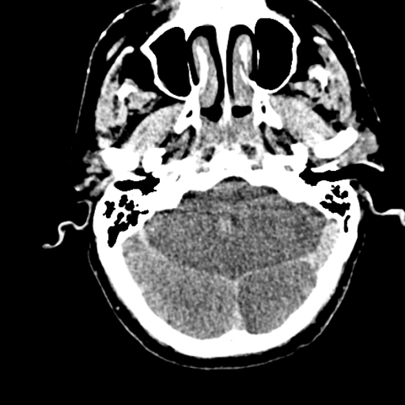 File:Basilar artery thrombosis (Radiopaedia 53351-59352 Axial non-contrast 34).jpg