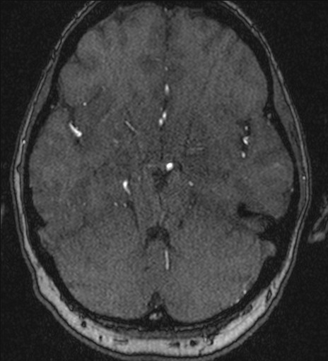 Basilar tip aneurysm (Radiopaedia 26504-26632 MRA 83).jpg
