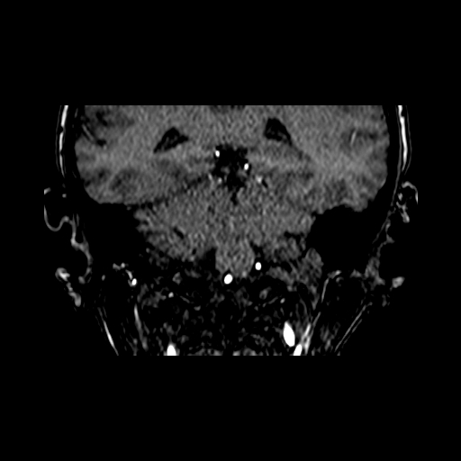 Berry aneurysm of the terminal internal carotid artery (Radiopaedia 88286-104918 Coronal TOF 72).jpg