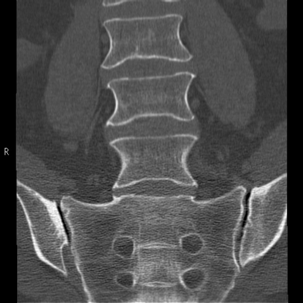 Bertolotti syndrome (Radiopaedia 24864-25128 Coronal bone window 18).jpg