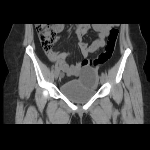 File:Bicornuate uterus- on MRI (Radiopaedia 49206-54296 Coronal non-contrast 6).jpg