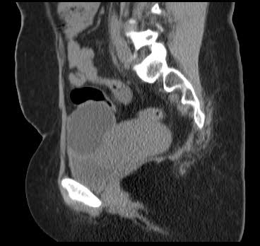 File:Bicornuate uterus (MRI) (Radiopaedia 49206-54296 Sagittal 4).png