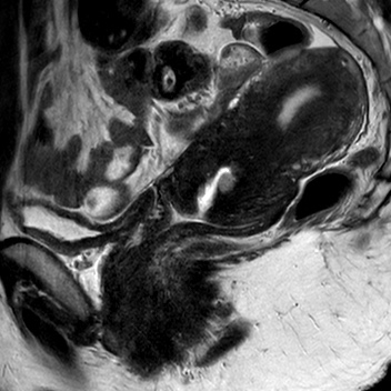 File:Bicornuate uterus (Radiopaedia 61974-70046 Sagittal T2 10).jpg