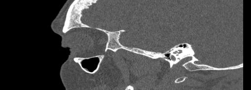 Bilateral Ectopic Infraorbital Nerves (Radiopaedia 49006-54084 Sagittal bone window 5).jpg